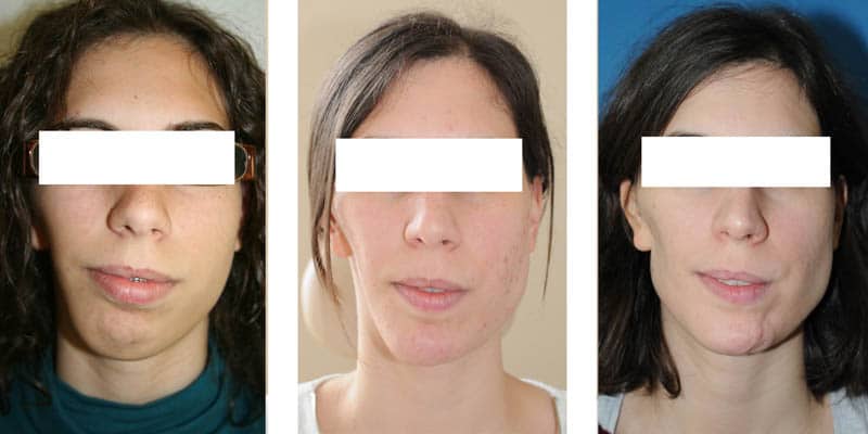 Planification 3D 3 3D chirurgie guidee chirurgien maxillo facial paris