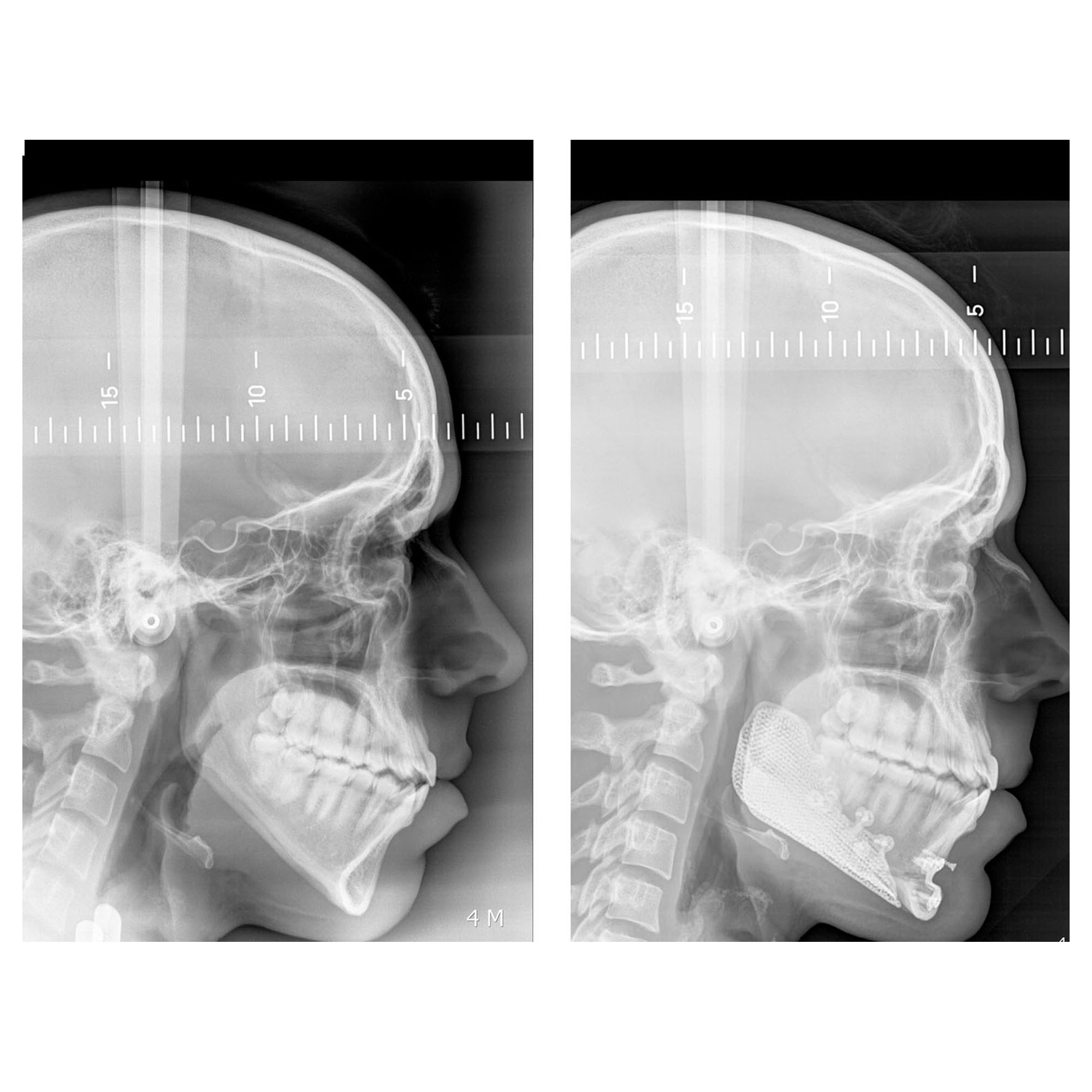 Implants mandibulaires angles mandibulaires 3D implant titane sur mesure france paris 6