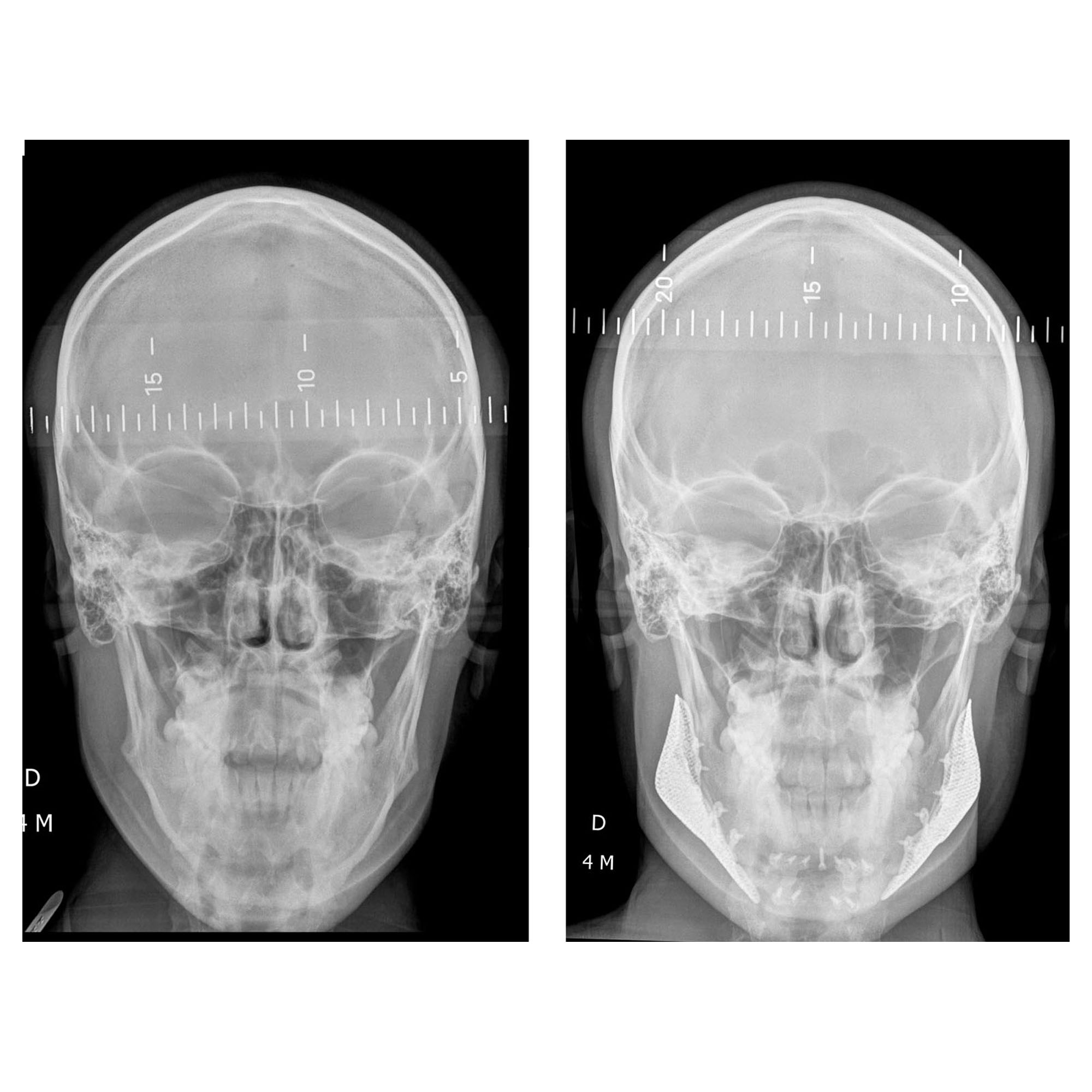 Implants mandibulaires angles mandibulaires 3D implant titane sur mesure france paris 7
