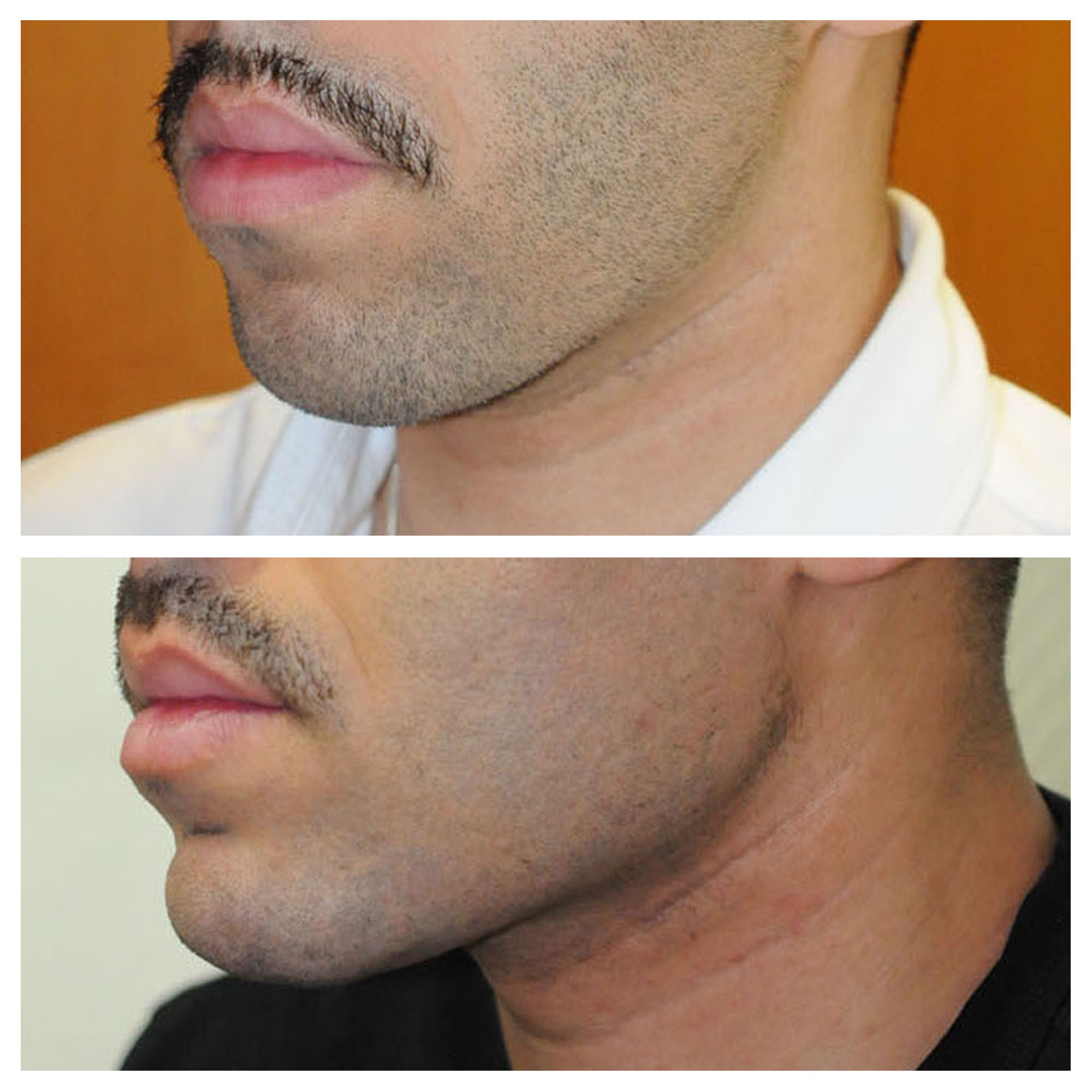 Implants mandibulaires angles mandibulaires 3D implant titane sur mesure france paris 13 1