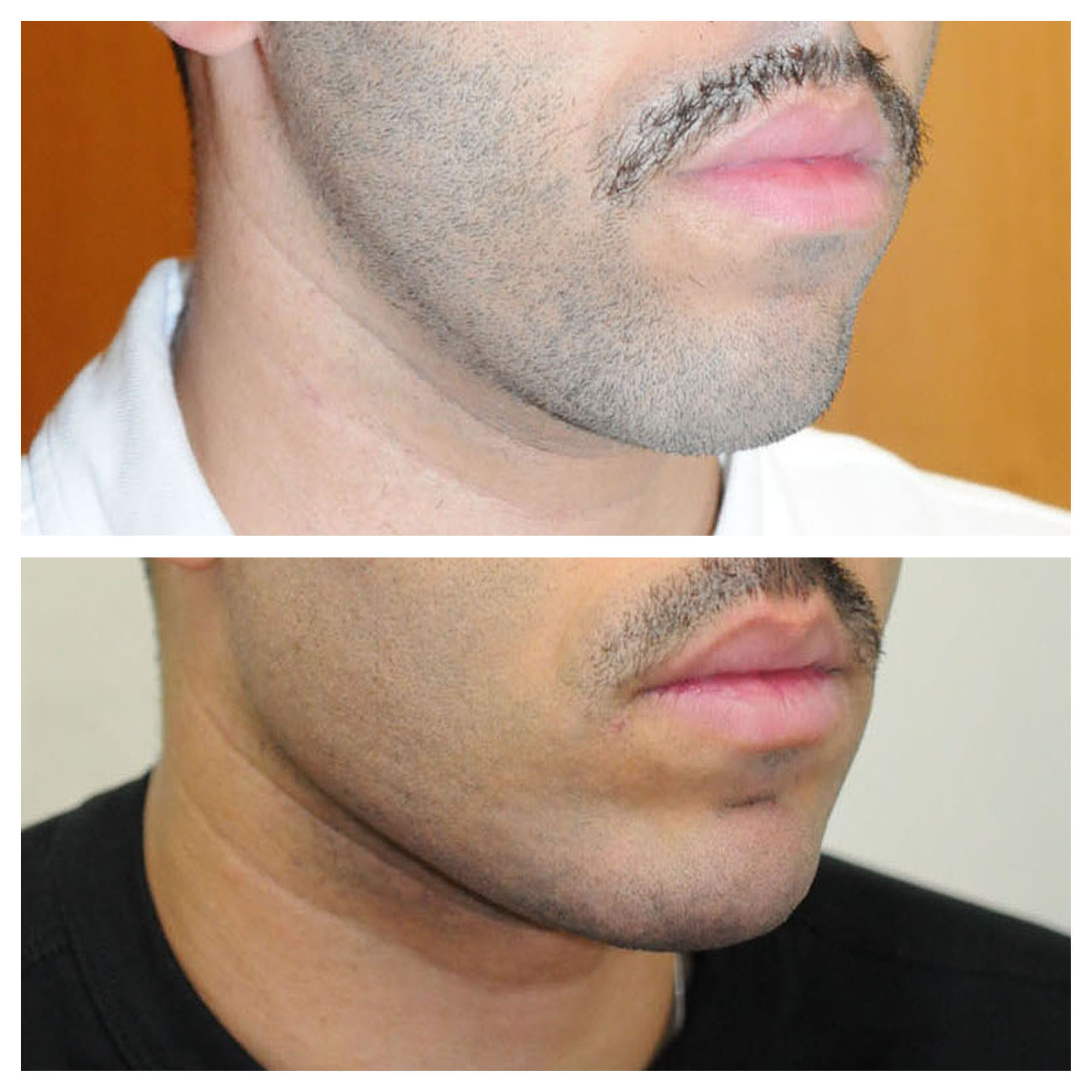 Implants mandibulaires angles mandibulaires 3D implant titane sur mesure france paris 14