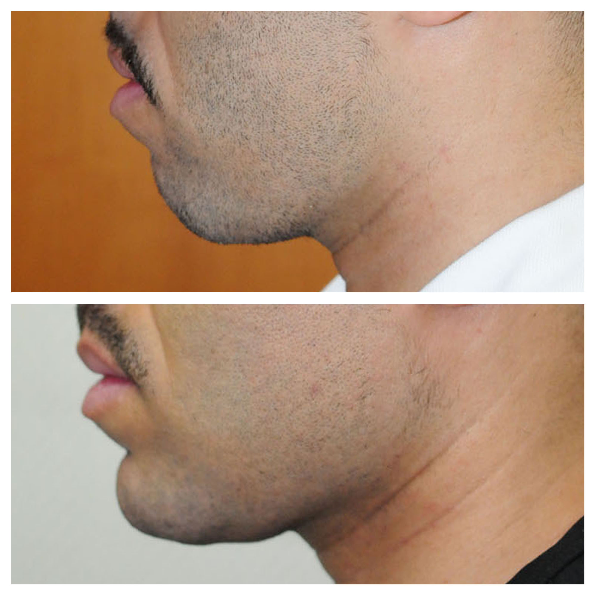 Implants mandibulaires angles mandibulaires 3D implant titane sur mesure france paris 13