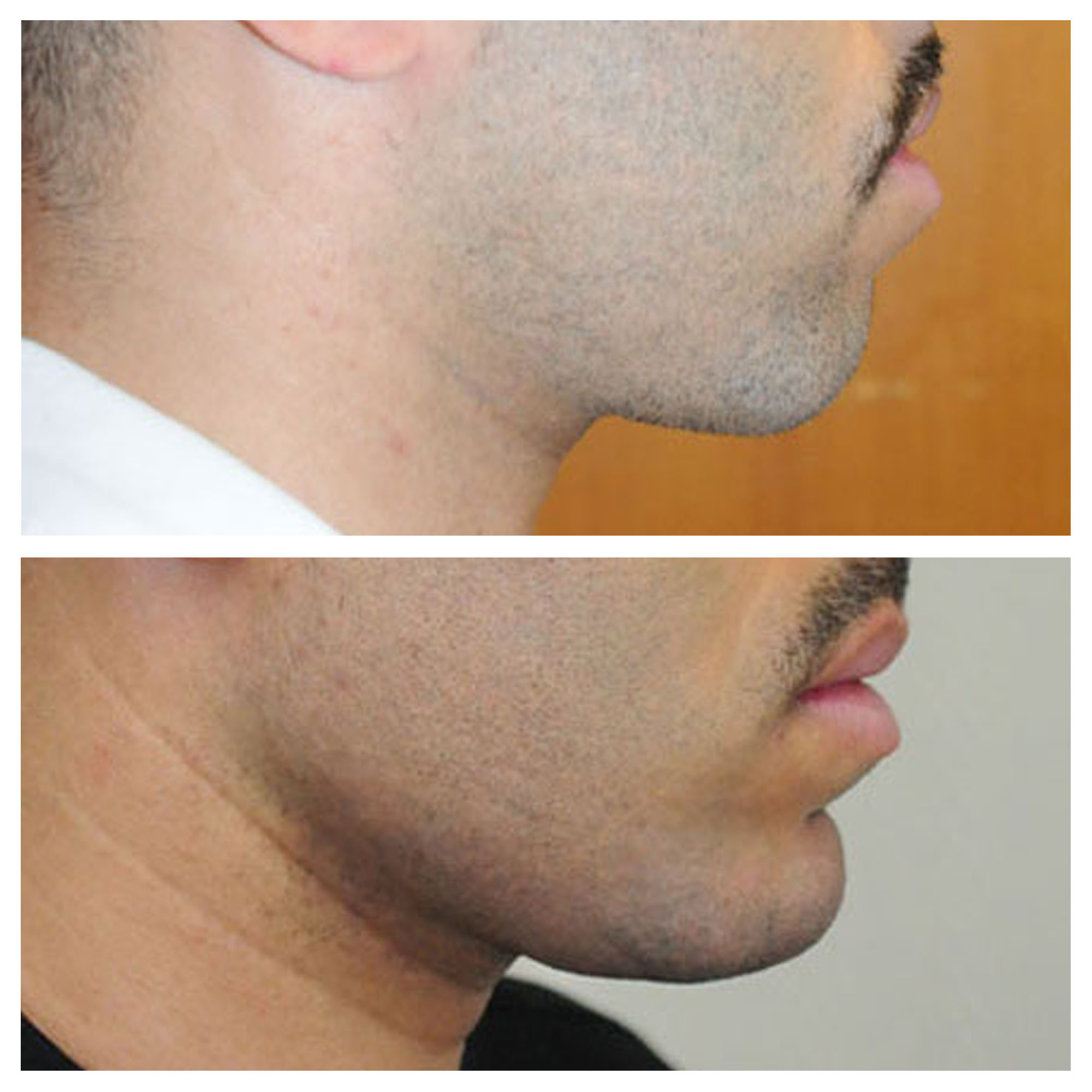 Implants mandibulaires angles mandibulaires 3D implant titane sur mesure france paris 11
