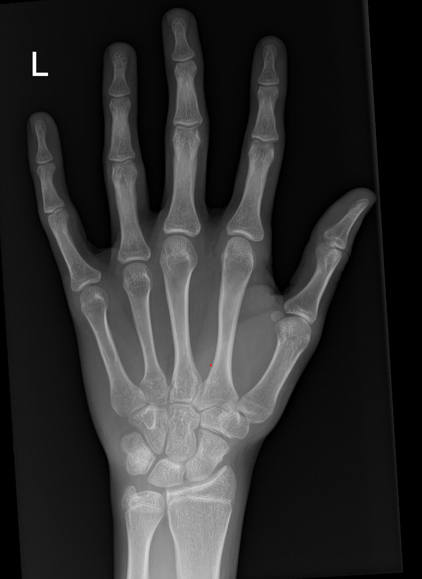Bone age