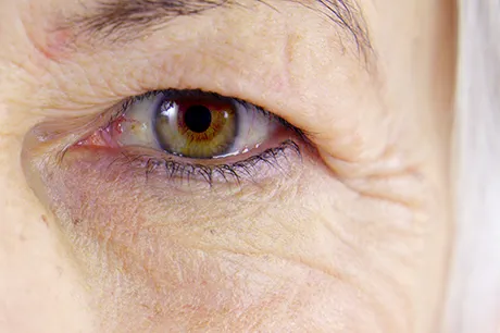 2023 04 droopy eyelids