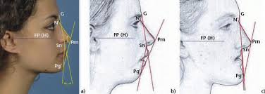 Jaw relationship and facial convexity ...