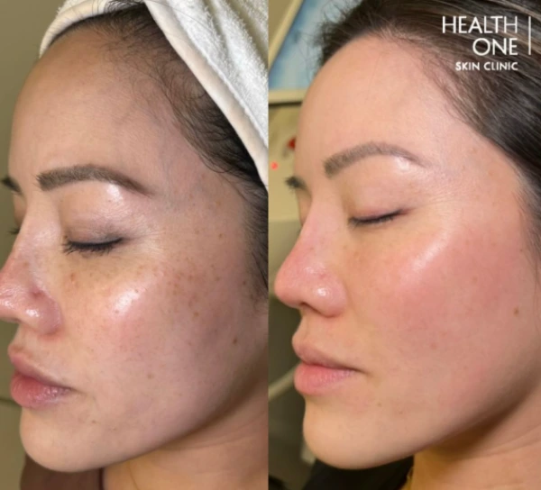 Hyperpigmentationbeforeandafter