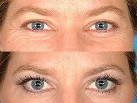 Eye lash transplant