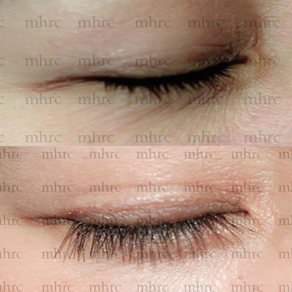 Eyelash transplant
