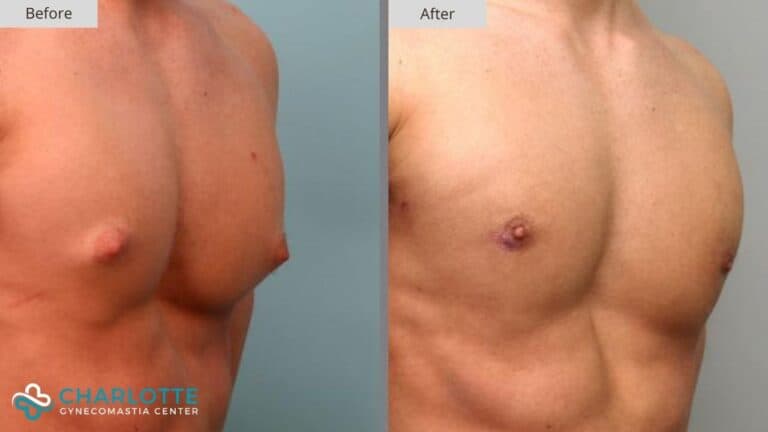 Charlotte Gynecomastia Before and After Patient 124b 768x432