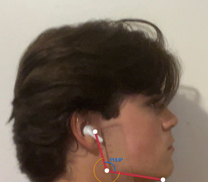 GonialAngle1