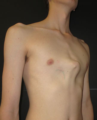 Pectus carinatum 4