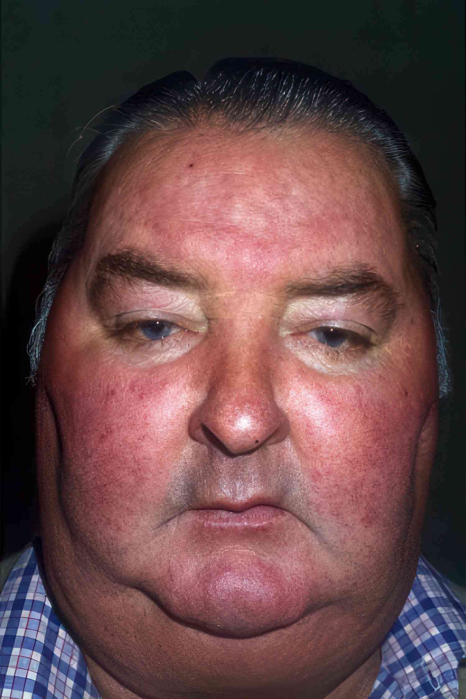VWH DermNetNZ Moon Face 01 e0c3be1d264346c68e7acfb4fd62c1f9