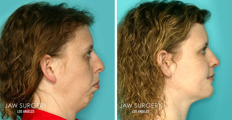 Before after patient 03 v2