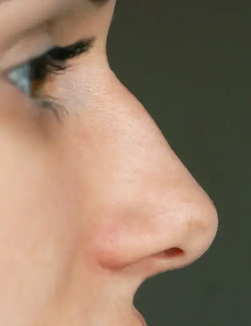 SAS-Nose-Bump-630x820.webp