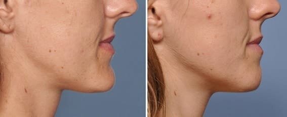 Mentoplastia reduccion 1 1663827135