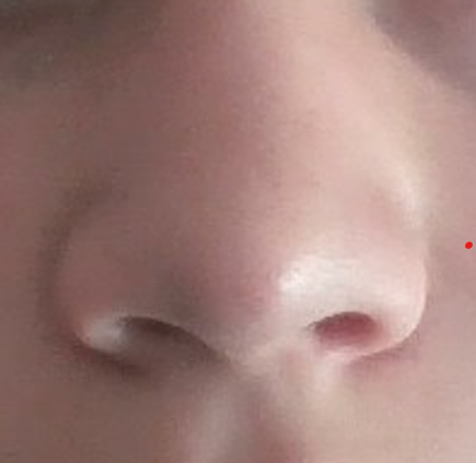 Before Bethamethasone