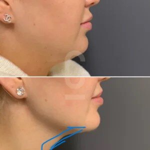 Fat-Dissolving-Injections-Female-1-300x300.jpg
