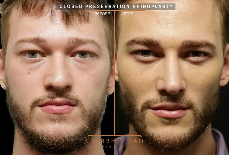 11216 1of5 Facial Implants before and after photos by Sherber and Rad in Washington DC
