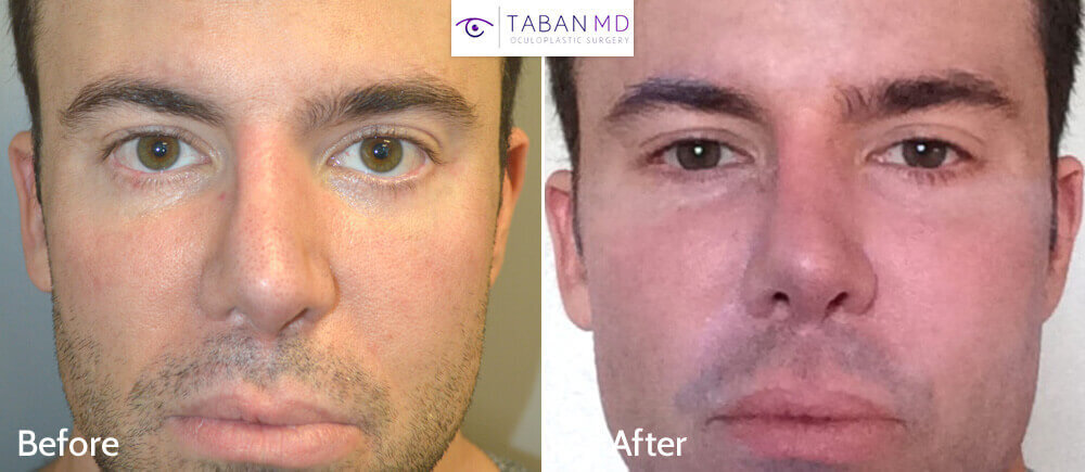 Before and after pic 1a