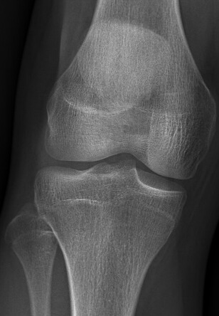 Knee 1