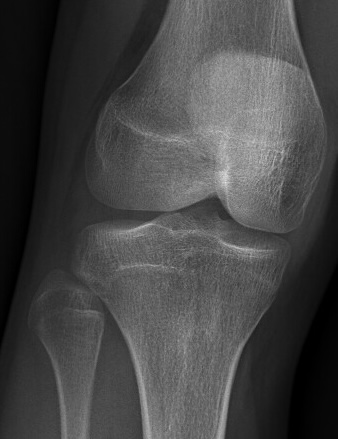 Knee 2