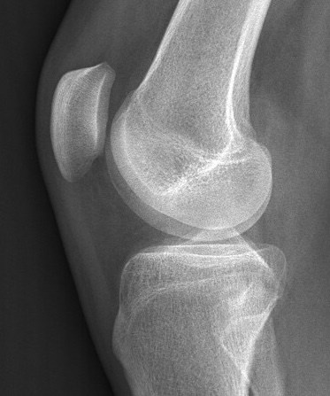 Knee 3