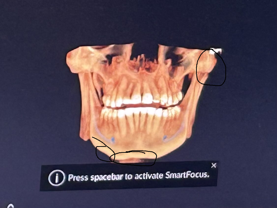 Bones