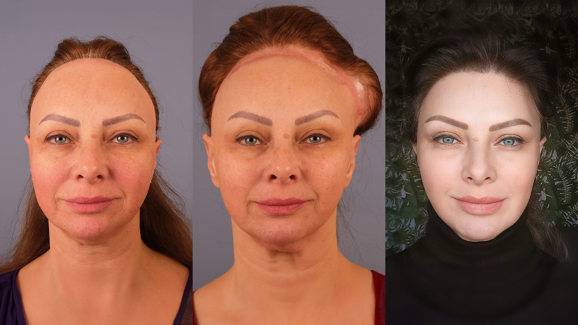 2 staged forehead by dr cengizhan 1920x1080