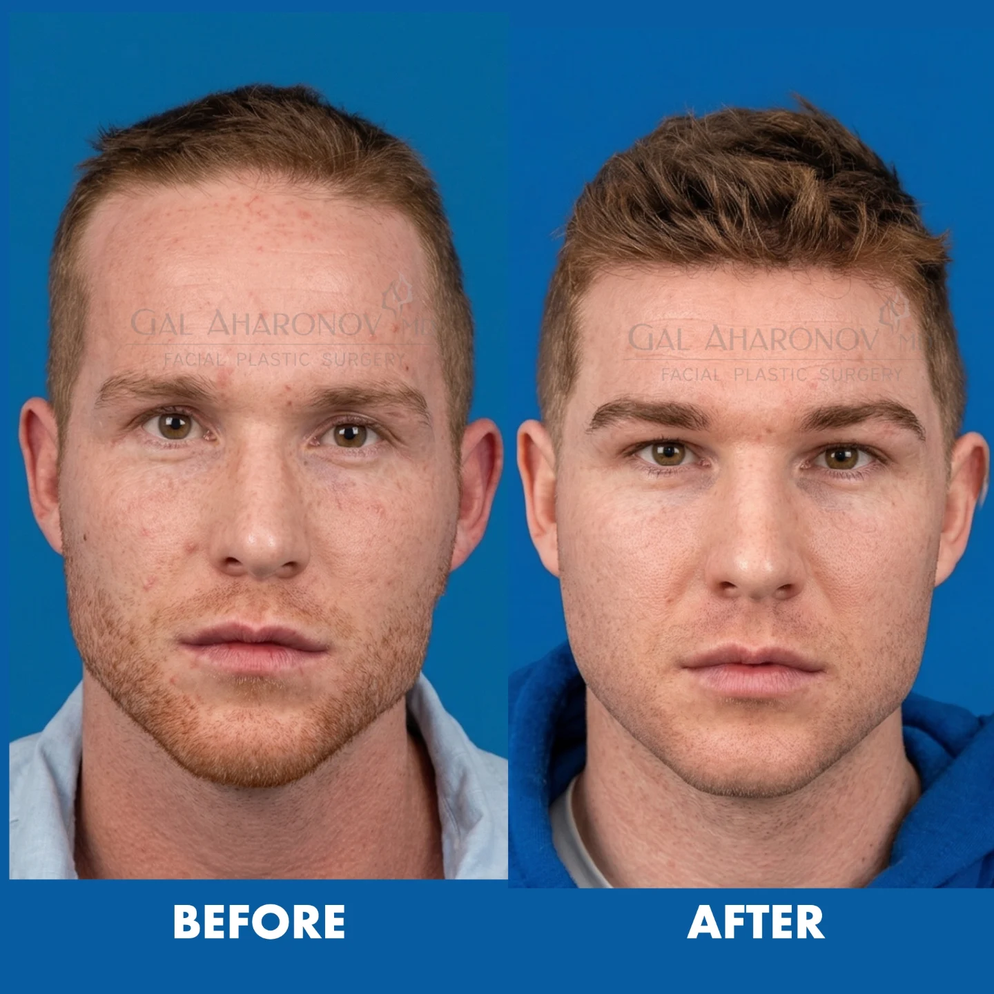 Hunter eyes and Hunter forehead We performed a forehead reduction surgery on this gentleman al