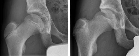 The distance between the lateral part of the proximal femoral growth plate and the growth