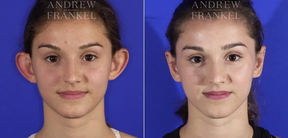Patient 3622 otoplasty before after 1200x575