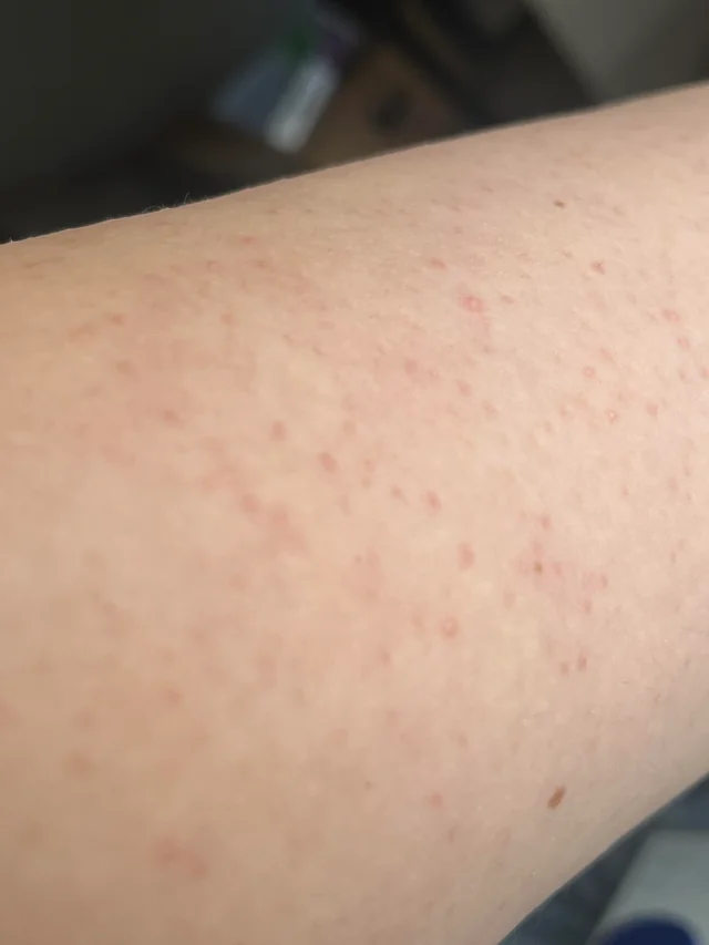 Armpimples