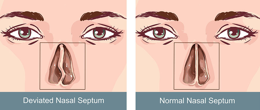 Deviated nasal septum illustration f52c94