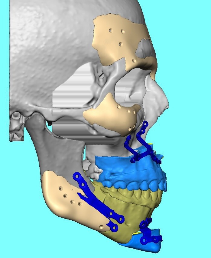 05 extra plan maxilla side