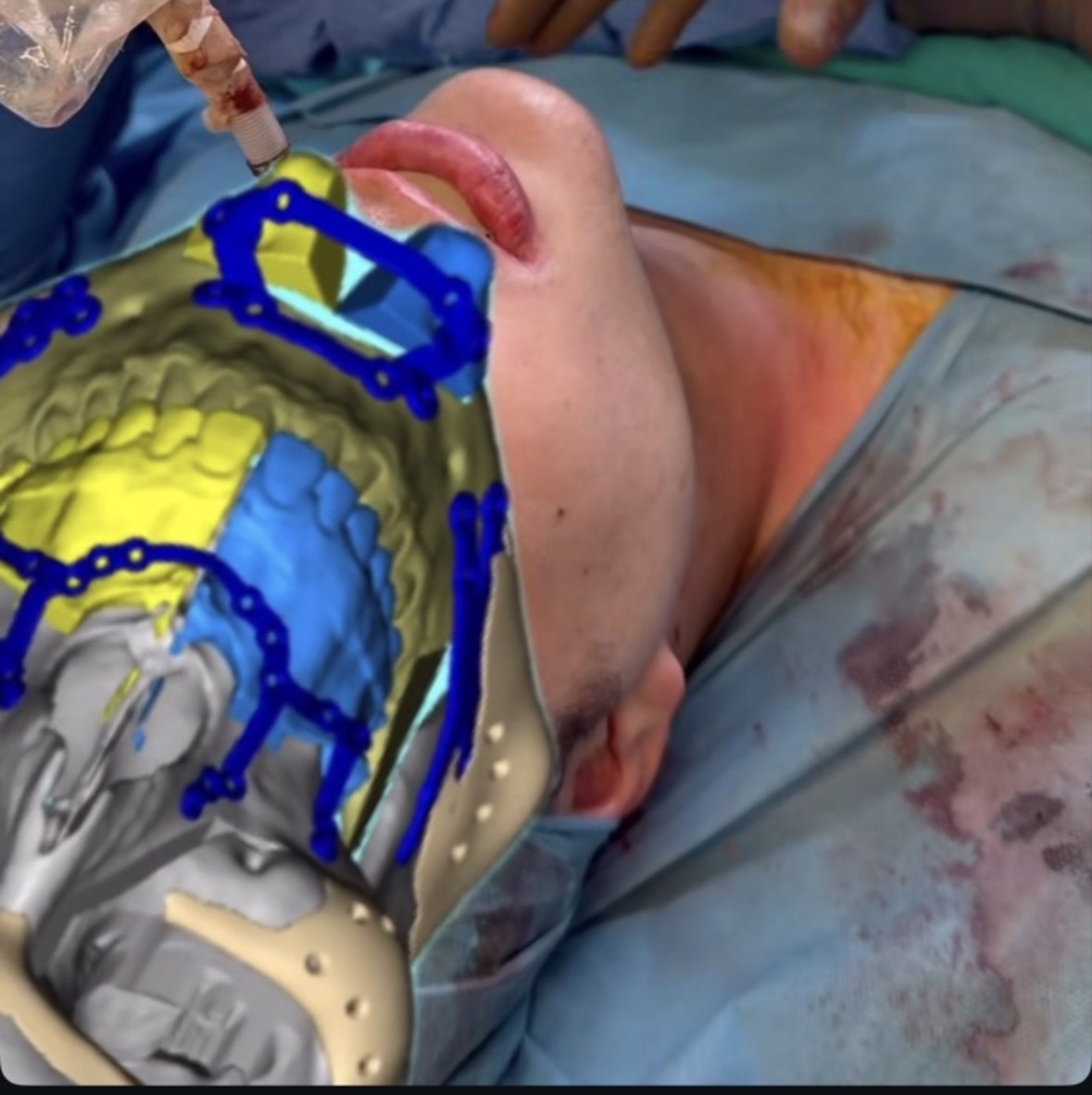 07 ar overlay intraop