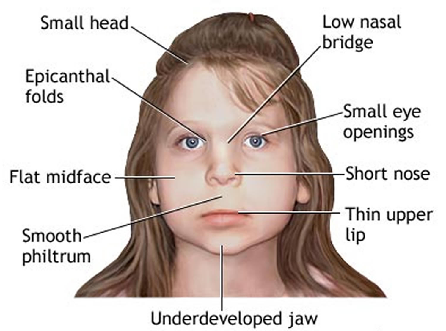Fetal alcohol syndrome 1 4113567427