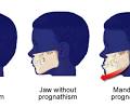 Prognathism - Forest & Ray - Dentists, Orthodontists ...