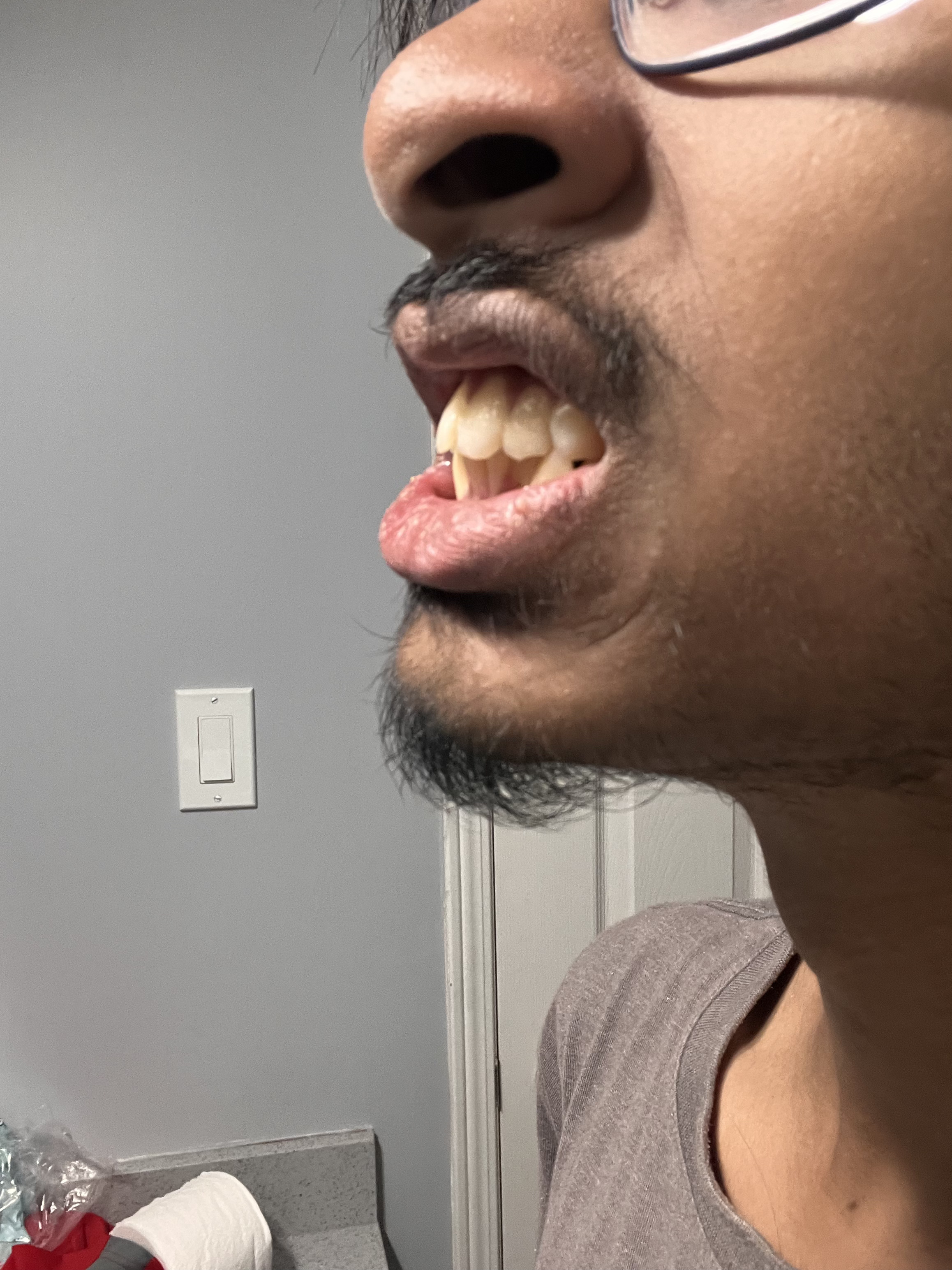 Overbite