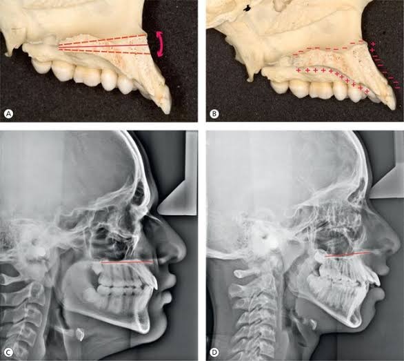 Craniofacial growth vectors and maxillary positioning, AI generated