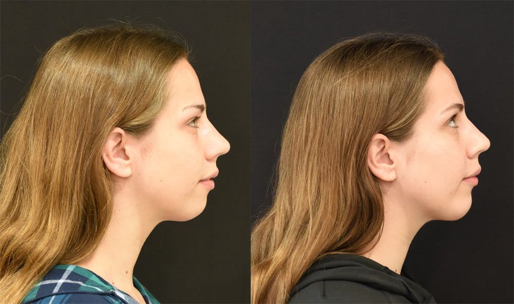 Recessed jaw