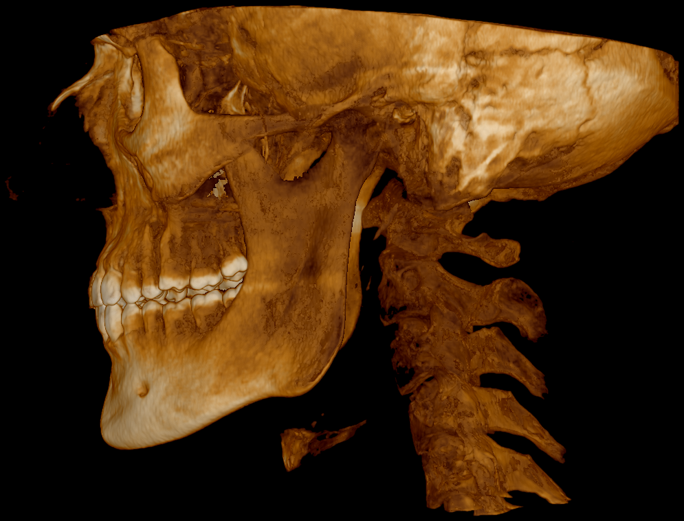Cbct left