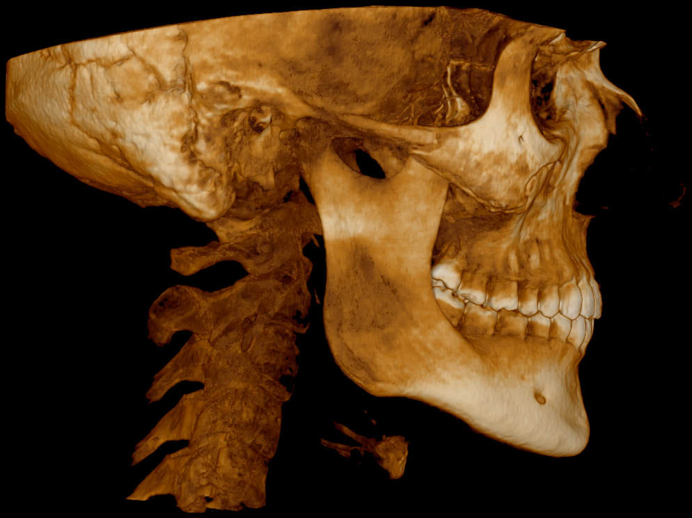 Cbct right