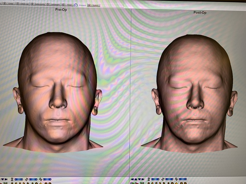 Simulated results front view