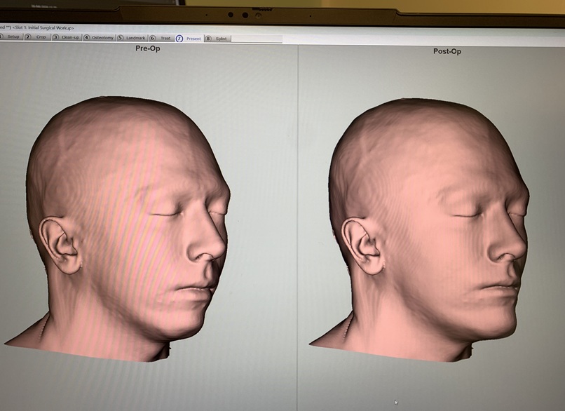 Simulated results 45 degree view