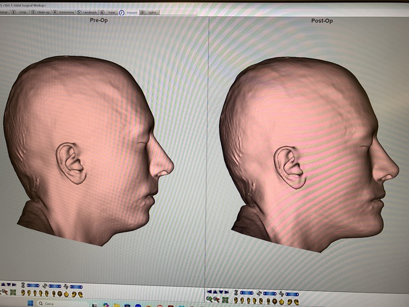 Simulated results side view