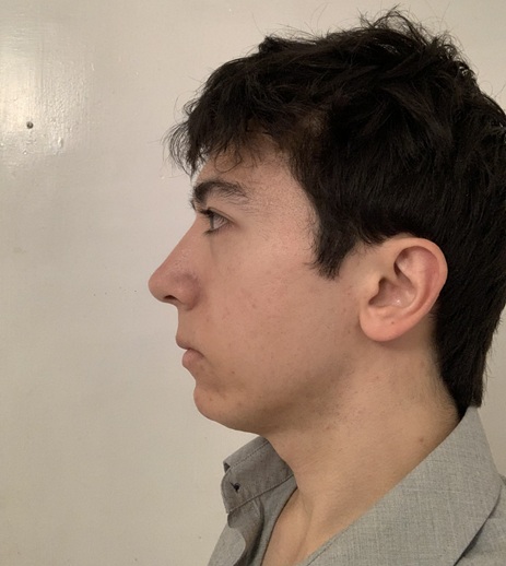 Side view right before surgery