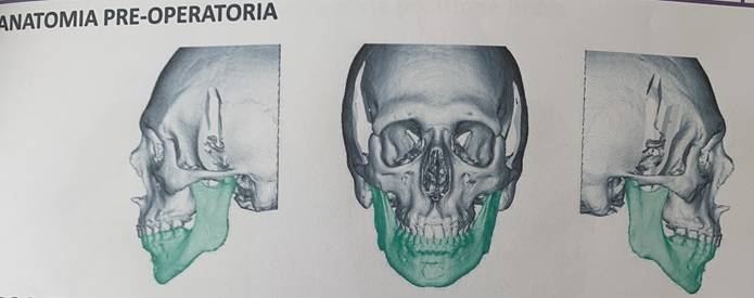 Initial position of bones before surgery