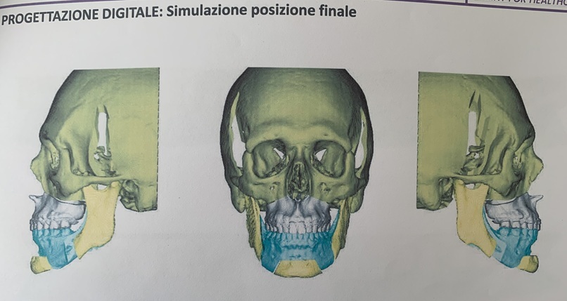 Final position of bones after surgery