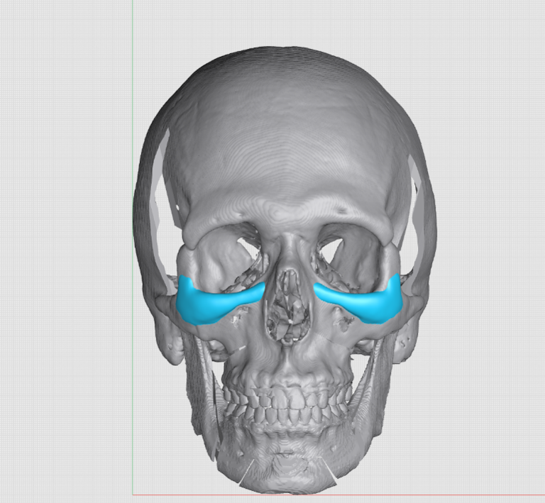 Infraorbital front view